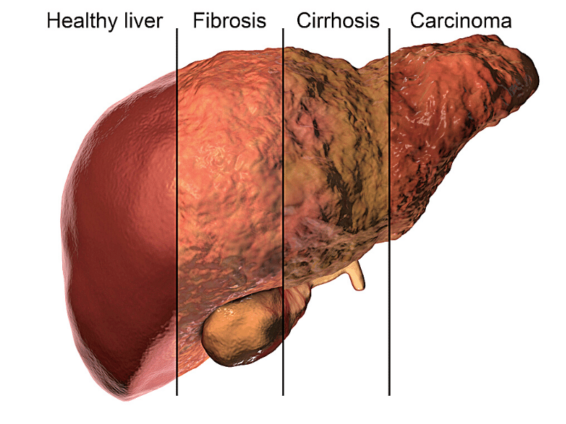 liver damage from alcohol